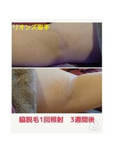 リオンズ 茨城ミスターマックス取手店/【メンズ脱毛】脇1回　3週間後