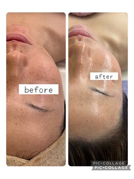 ルピナージュ(Lupinage)/【肌質改善】‐毛穴ニキビケア-