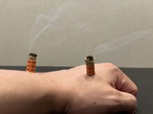 ラックス鍼灸 整体院(Lachs鍼灸 整体院)/お灸やってます！