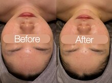 クレヴィア バイ サイバーエステ(CREBIA)/【小顔コルギ】即効性あり☆