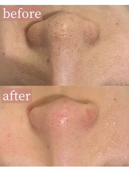 アディクトウラ(Addict'ula)/毛穴エクストラクション