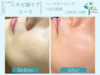 ボディコンディション/ハーブピーリング/毛穴洗浄/小顔