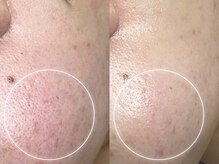 キヌ(KINU)/症例写真（赤み）