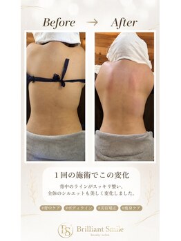 ブリリアントスマイル/二の腕背中の肉にボディメイク