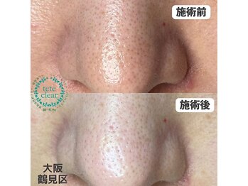 リッカロッカ(RIKKA&ROCCA)/毛穴が変わると肌も変わる