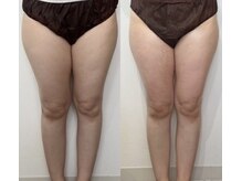 リリー(Lily)/セルゼロ下半身