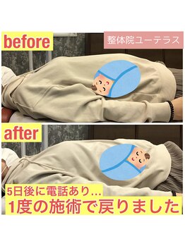 ユーテラス/32週の逆さ子が1回施術で改善！