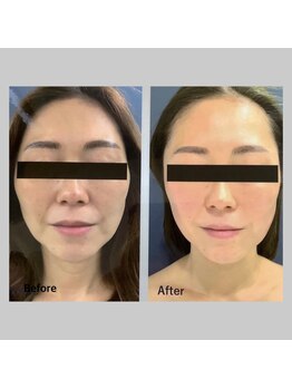 ブローチ 岡崎店(BROOCH)/究極小顔BHF効果◎2