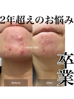 サロンツキ(salon tuki)/幹細胞ピーリング症例