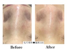 フレイヤ(FREYA)/毛穴専科Before→After