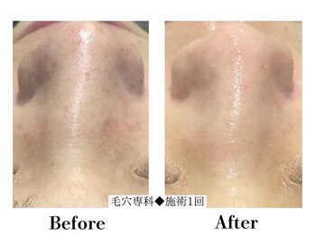 フレイヤ(FREYA)/毛穴専科Before→After