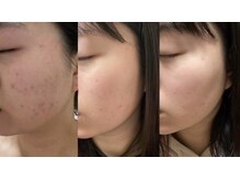 シャルム エスボーテ(charme Esbeaute)/スキンケアのみ使用