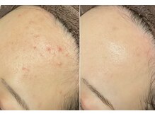 ベルティーク(BELTHEQUE)の雰囲気（【生理前の肌荒れ】無理のない月1ケアでトラブル知らずのお肌に）