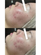 フィール(feel)/ビフォー　アフター　1回施術