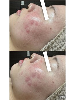 フィール(feel)/ビフォー アフター 1回施術