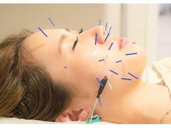 アモ(amo)/美容鍼