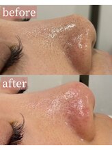 アディクトウラ(Addict'ula)/毛穴エクストラクション