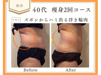 リュミエール(Lumiere)/【症例】お腹脂肪撃退