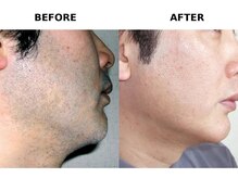 自由が丘ダツモウセンター(自由が丘 DATSUMOW CENTER)/ヒゲ脱毛～男性A様～