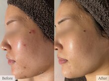 ティアラッシュ(TiaLash)/HAAB REPRO