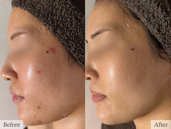 ティアラッシュ(TiaLash)/HAAB REPRO