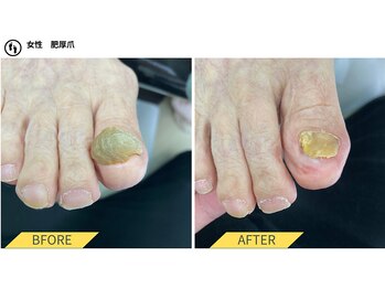 ふっとけ庵/肥厚爪ケア