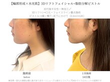 サボラミ(sabor A Mi)/たるみ+脂肪ケア　2種類の施術