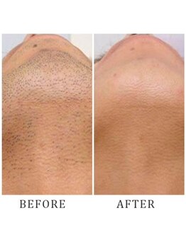 セカンドフロア バイ ブレスト ハコダテ(2nd floor by BLESSED HKD)/高出力で最短卒業ヒゲ脱毛