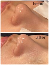 ビースキン(B SKIN)/セラミド毛穴洗浄