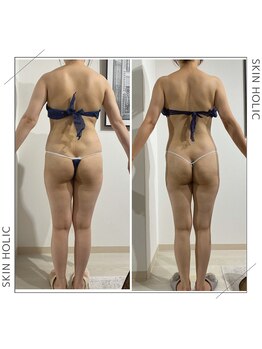 スキンホリック 恵比寿駅前店(SKIN HOLIC)/全身☆痩身ビフォア＆アフター★