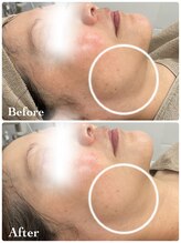 ミレーヴ(MiReve)/小顔・リフトアップ