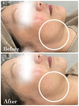 ミレーヴ(MiReve)/小顔・リフトアップ