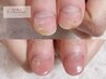 女性限定！人気!【深爪矯正】即日長さだし！スキンカラー仕上げ13000→12000