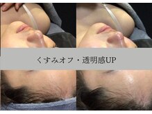 ラリマ グラマラス(Larima Glamorous)/2回目でここまで変わる透明感