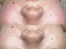 キヌ(KINU)/症例写真（赤み）