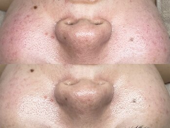 キヌ(KINU)/症例写真（赤み）