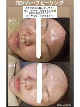 ココ(COCO)の写真/【徹底毛穴洗浄◎】revi ハーブピーリングで毛穴の詰まりをごっそり大掃除！！毛穴/ニキビケア/肌質改善♪