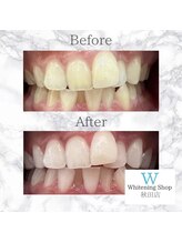ホワイトニングショップ 秋田店/【before after】 美白