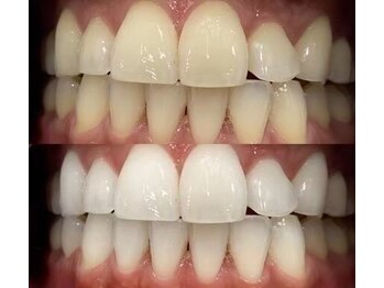 アルエット(Alouette)/ホワイトニングbefore/after