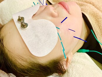 ミエリア美容鍼灸院(mielia美容鍼灸院)/mieliaハーフリフト2部位(16本)