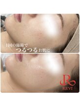 ミレーヴ(MiReve)/ブライダル・小顔