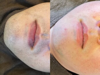 モモ(Momo.)/髭脱毛