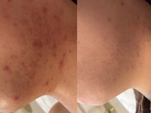 リラ(Lilas)/ハーブピーリング