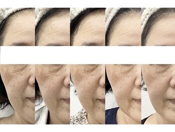 クレア 半田店(Crea)の写真/シミ・赤み・毛穴・ハリ不足に◎パワーアップしたDPL光フェイシャルで今までにない艶肌を目指す!