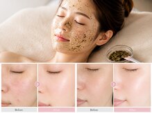 アースコアフュールボーテ つくば学園店(EARTH coiffure beaute)の雰囲気（ハーブピーリング（ソフト）￥11000→￥6600【ニキビ/つくば】）