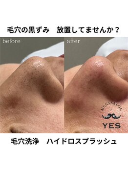 イエス 佐賀店(YES)/毛穴洗浄ビフォーアフター