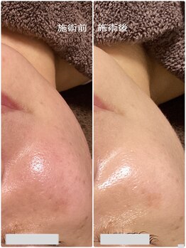 ブライトリー(Brightly)/施術直後から叶う美肌!