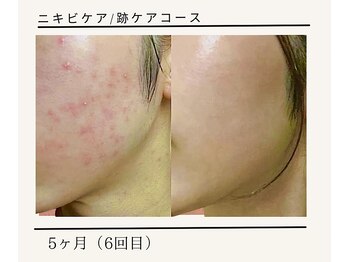 ルミエールフォートサイド(L’MIERE fortside)/お悩み:肌荒れ,毛穴