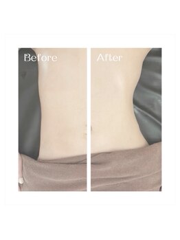 華月(KAGETSU)/初日で実感！NRで痩身体験！