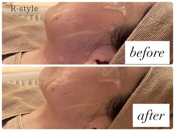 エステサロン アールスタイル(R-style)/テラボーラービフォアフター写真